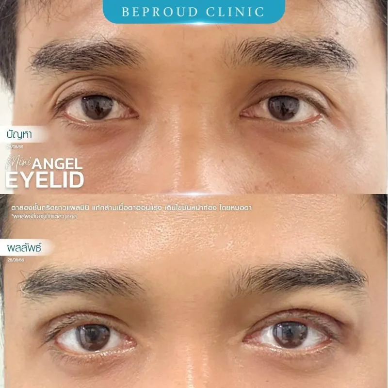 ภาพรีวิวเปรียบเทียบผลลัพธ์ ก่อนทำ-หลังทำศัลยกรรมตาสองชั้นผู้ชาย ของเคสตัวอย่าง เทคนิคกรีดตายาวแผลมินิ เติมไขมันหน้าท้อง แก้กล้ามเนื้อตาอ่อนแรง โดยหมอดา บีพราวด์คลินิก