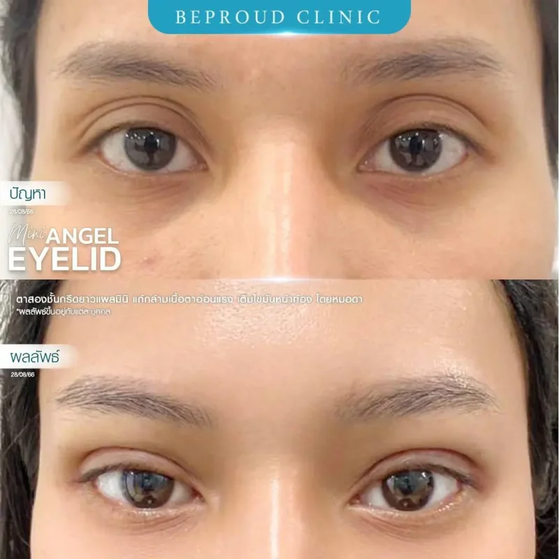 ภาพรีวิวเปรียบเทียบผลลัพธ์ ก่อนทำ-หลังทำศัลยกรรมตาสองชั้น ของเคสตัวอย่าง เทคนิคกรีดตายาวแผลมินิ เติมไขมันหน้าท้อง แก้กล้ามเนื้อตาอ่อนแรง โดยหมอดา บีพราวด์คลินิก