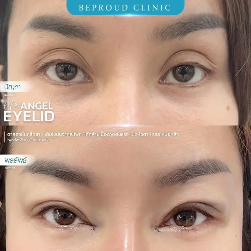 ภาพรีวิวเปรียบเทียบผลลัพธ์ ก่อนทำ-หลังทำศัลยกรรมตาสองชั้น ของเคสตัวอย่าง เทคนิคกรีดตายาว เติมไขมันจากสะโพก เปิดหัวตา แก้กล้ามเนื้อตาอ่อนแรง โดยอ.หมอหลิง บีพราวด์คลินิก