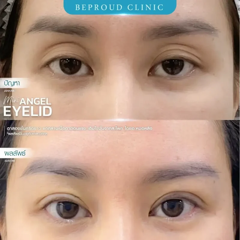 ภาพรีวิวเปรียบเทียบผลลัพธ์ ก่อนทำ-หลังทำศัลยกรรมตาสองชั้น ของเคสตัวอย่าง เทคนิคกรีดตายาว แก้กล้ามเนื้อตาอ่อนแรง เติมไขมันจากสะโพก โดยอ.หมอหลิง บีพราวด์คลินิก