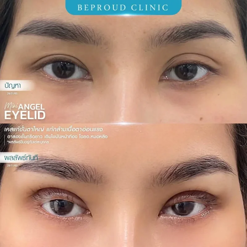 ภาพรีวิวเปรียบเทียบผลลัพธ์ ก่อนทำ-หลังทำศัลยกรรมแก้ชั้นตาใหญ่ ของเคสตัวอย่าง เทคนิคกรีดตายาว เติมไขมันหน้าท้อง แก้กล้ามเนื้อตาอ่อนแรง โดยอ.หมอหลิง บีพราวด์คลินิก