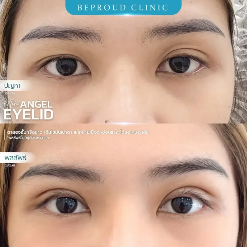 ภาพรีวิวเปรียบเทียบผลลัพธ์ ก่อนทำ-หลังทำศัลยกรรมตาสองชั้น ของเคสตัวอย่าง เทคนิคกรีดตายาว เติมไขมันเบ้าตา แก้กล้ามเนื้อตาอ่อนแรง โดยอ.หมอหลิง บีพราวด์คลินิก