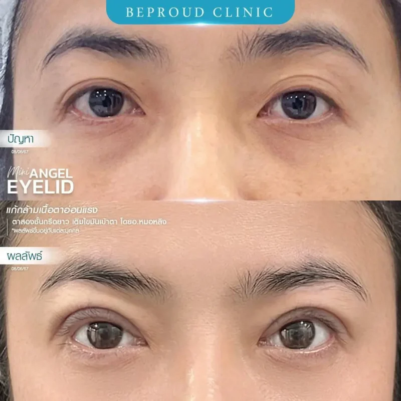 ภาพรีวิวเปรียบเทียบผลลัพธ์ ก่อนทำ-หลังทำศัลยกรรมตาสองชั้น ของเคสตัวอย่าง เทคนิคกรีดตายาว แก้กล้ามเนื้อตาอ่อนแรง เติมไขมันเบ้าตา โดยอ.หมอหลิง บีพราวด์คลินิก