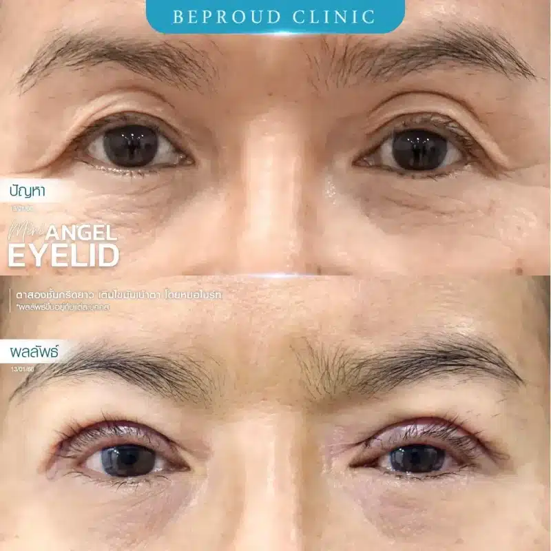 ภาพรีวิวเปรียบเทียบผลลัพธ์ ก่อนทำ-หลังทำศัลยกรรมตาสองชั้นผู้สูงอายุ ของเคสตัวอย่าง เทคนิคกรีดตายาว เติมไขมันเบ้าตา โดยหมอไบร์ท บีพราวด์คลินิก
