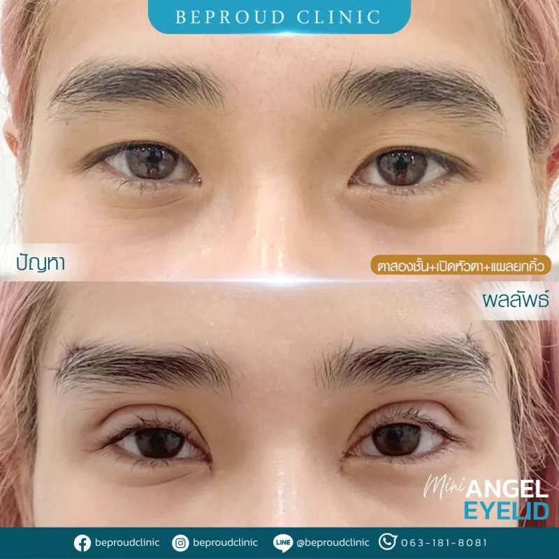 ภาพรีวิวเปรียบเทียบผลลัพธ์ ก่อนทำ-หลังทำศัลยกรรมตาสองชั้น ของเคสตัวอย่าง เทคนิคกรีดตายาว เปิดหัวตา แผลใต้คิ้ว โดยอ.หมอหลิง บีพราวด์คลินิก