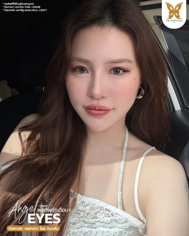 ภาพรีวิวคนสวย เปิดหางตา กดตาล่าง โดยหมอต้น (นพ.จิรัฐ) บีพราวด์คลินิก แสดงผลลัพธ์ ชั้นตาสวยคมชัด ดวงตาดูสดใส