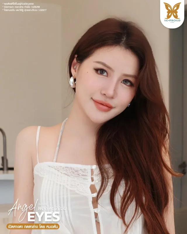 ภาพรีวิวคนสวย เปิดหางตา กดตาล่าง โดยหมอต้น (นพ.จิรัฐ) บีพราวด์คลินิก แสดงผลลัพธ์ ชั้นตาสวยคมชัด ดวงตาดูสดใส