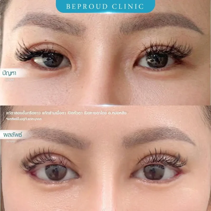 ภาพรีวิวเปรียบเทียบผลลัพธ์ ก่อนทำ-หลังทำศัลยกรรมแก้ตาสองชั้น ของเคสตัวอย่าง เทคนิคกรีดตายาว เปิดหางตา เปิดหัวตา แก้กล้ามเนื้อตาอ่อนแรง โดยอ.หมอหลิง บีพราวด์คลินิก