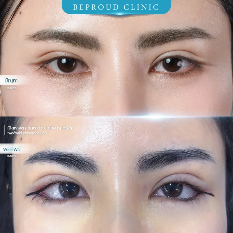 ภาพรีวิวเปรียบเทียบผลลัพธ์ ก่อนทำ-หลังทำศัลยกรรม ของเคสตัวอย่าง เปิดหางตาและกดตาล่าง โดยอ.หมอหลิง บีพราวด์คลินิก