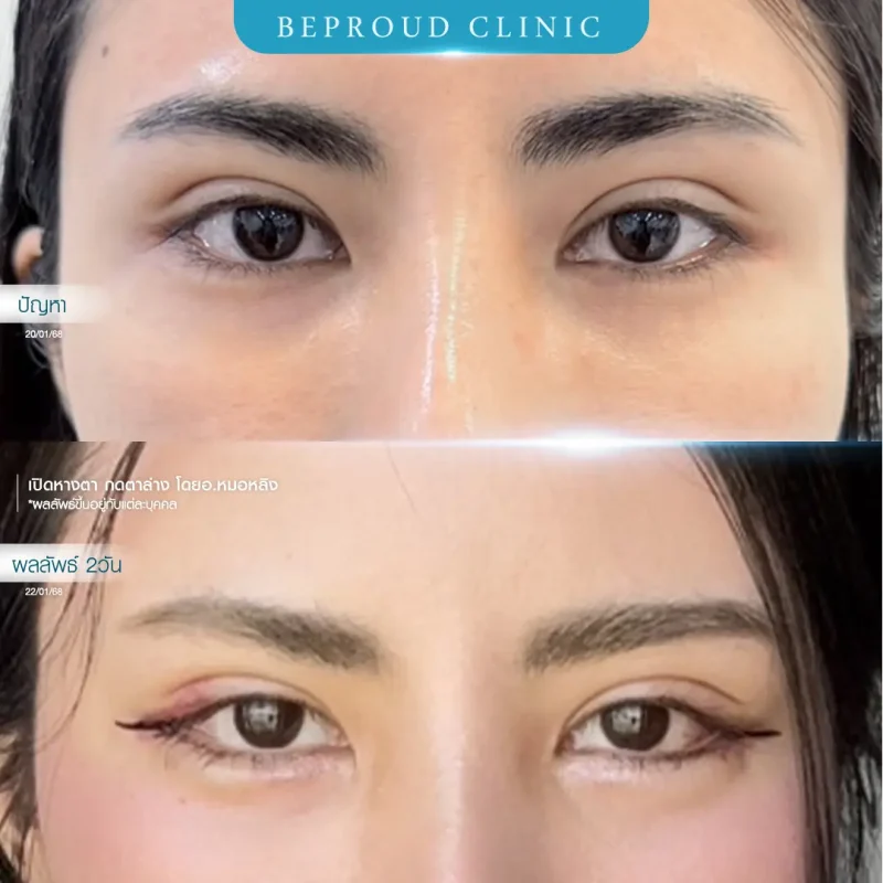 ภาพรีวิวเปรียบเทียบผลลัพธ์ ก่อนทำ-หลังทำศัลยกรรม ของเคสตัวอย่าง เปิดหางตาและกดตาล่าง โดยอ.หมอหลิง บีพราวด์คลินิก