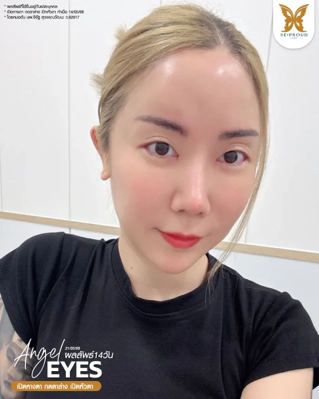 ภาพรีวิวคนสวย เปิดหางตา กดตาล่าง เปิดหัวตา โดยหมอต้น (นพ.จิรัฐ) บีพราวด์คลินิก แสดงผลลัพธ์ ชั้นตาสวยคมชัด ดวงตาดูสดใส