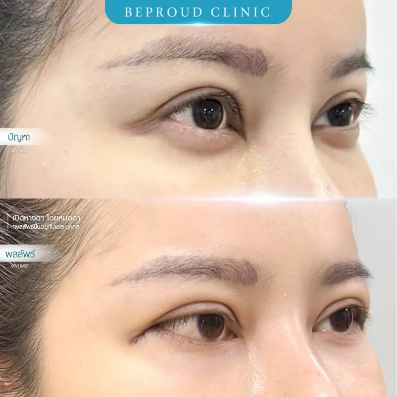 ภาพรีวิวเปรียบเทียบผลลัพธ์ ก่อนทำ-หลังทำศัลยกรรมเปิดหางตา โดยหมอดา บีพราวด์คลินิก