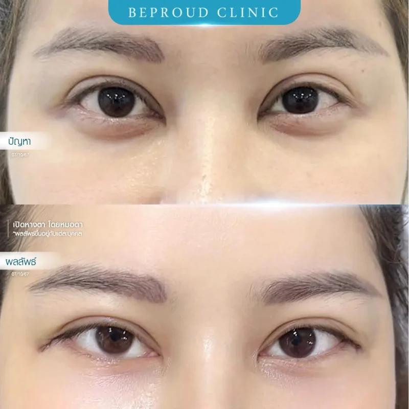 ภาพรีวิวเปรียบเทียบผลลัพธ์ ก่อนทำ-หลังทำศัลยกรรมเปิดหางตา โดยหมอดา บีพราวด์คลินิก