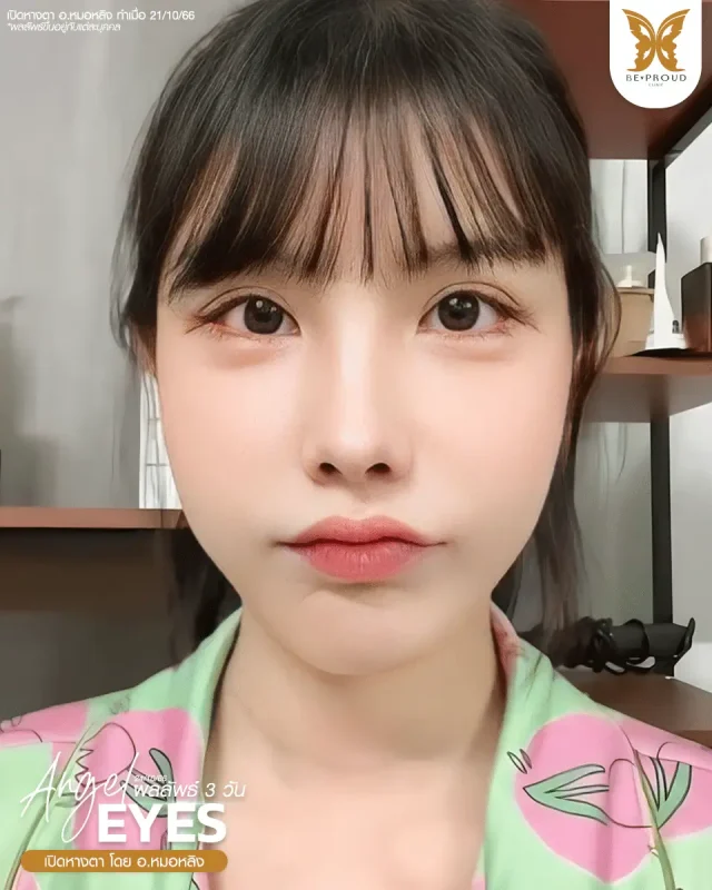 ภาพรีวิวคนสวย เปิดหางตา โดย อ.หมอหลิง (พญ.กัญญ์ชิสา) บีพราวด์คลินิก แสดงผลลัพธ์ ชั้นตาสวยคมชัด ดวงตาดูสดใส