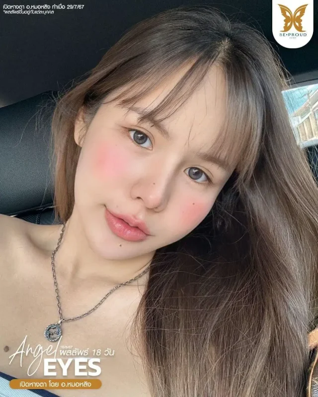 ภาพรีวิวคนสวย เปิดหางตา โดย อ.หมอหลิง (พญ.กัญญ์ชิสา) บีพราวด์คลินิก แสดงผลลัพธ์ ชั้นตาสวยคมชัด ดวงตาดูสดใส