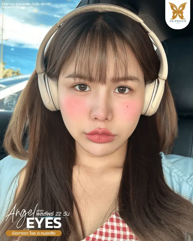 ภาพรีวิวคนสวย เปิดหางตา โดย อ.หมอหลิง (พญ.กัญญ์ชิสา) บีพราวด์คลินิก แสดงผลลัพธ์ ชั้นตาสวยคมชัด ดวงตาดูสดใส