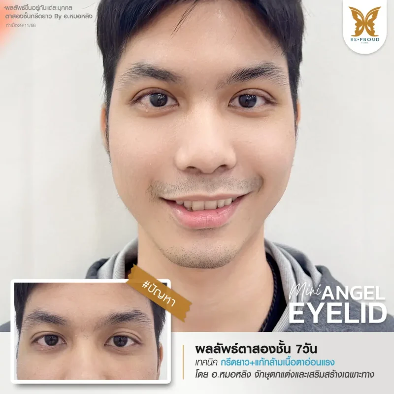 ภาพรีวิวเปรียบเทียบผลลัพธ์ ก่อนทำ-หลังทำศัลยกรรมตาสองชั้นผู้ชาย ของเคสตัวอย่าง เทคนิคกรีดตายาว แก้กล้ามเนื้อตาอ่อนแรง โดยอ.หมอหลิง บีพราวด์คลินิก