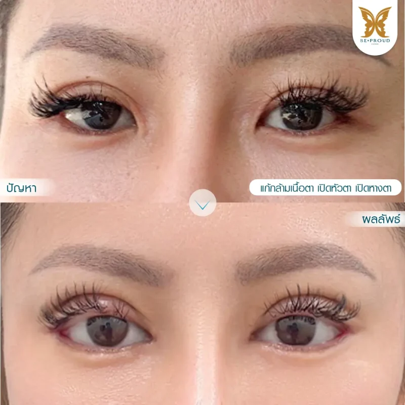 ภาพรีวิวเปรียบเทียบผลลัพธ์ ก่อนทำ-หลังทำศัลยกรรมแก้ตาสองชั้น ของเคสตัวอย่าง เทคนิคกรีดตายาว แก้กล้ามเนื้อตาอ่อนแรง เปิดหัวตา เปิดหางตา โดยอ.หมอหลิง บีพราวด์คลินิก