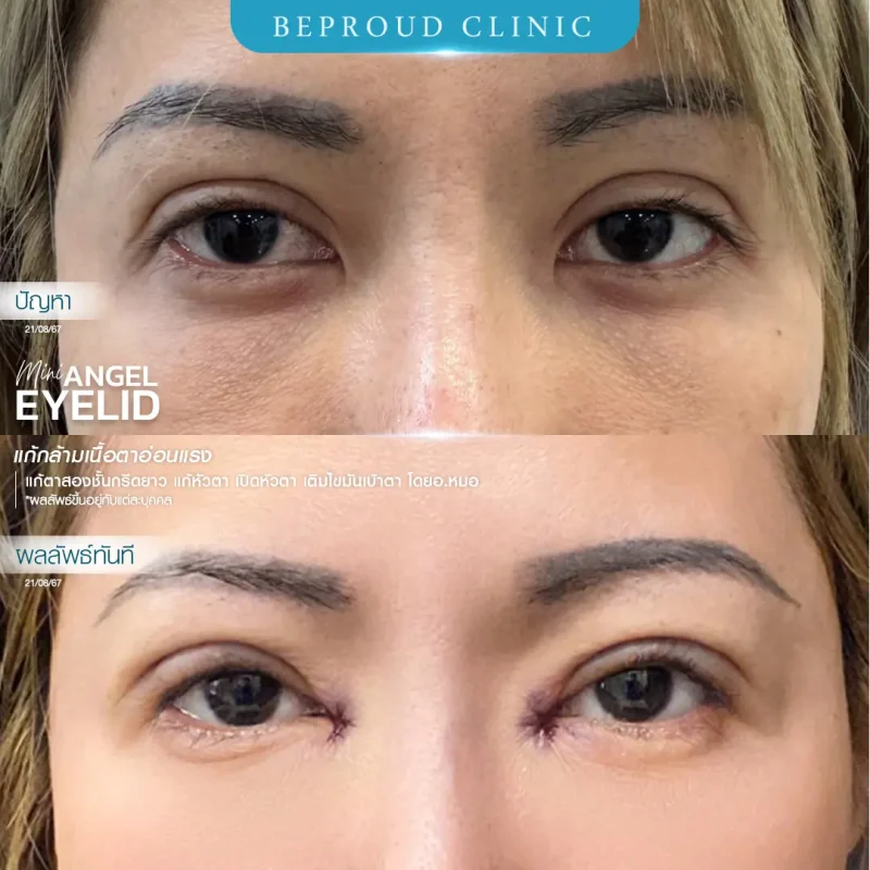 ภาพรีวิวเปรียบเทียบผลลัพธ์ ก่อนทำ-หลังทำศัลยกรรมแก้ตาสองชั้น ของเคสตัวอย่าง เทคนิคกรีดตายาว แก้หัวตา เปิดหัวตา เติมไขมันเบ้าตา แก้กล้ามเนื้อตาอ่อนแรง โดยอ.หมอหลิง บีพราวด์คลินิก
