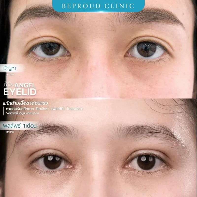 ภาพรีวิวเปรียบเทียบผลลัพธ์ ก่อนทำ-หลังทำศัลยกรรมตาสองชั้น ของเคสตัวอย่าง เทคนิคกรีดตายาว แก้กล้ามเนื้อตาอ่อนแรง เปิดหัวตา แผลใต้คิ้ว โดยหมอดา บีพราวด์คลินิก