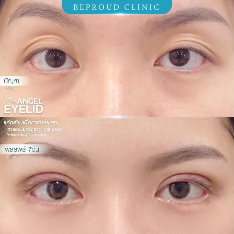 ภาพรีวิวเปรียบเทียบผลลัพธ์ ก่อนทำ-หลังทำศัลยกรรมตาสองชั้น ของเคสตัวอย่าง เทคนิคกรีดตายาว แก้กล้ามเนื้อตาอ่อนแรง โดยหมอดา บีพราวด์คลินิก
