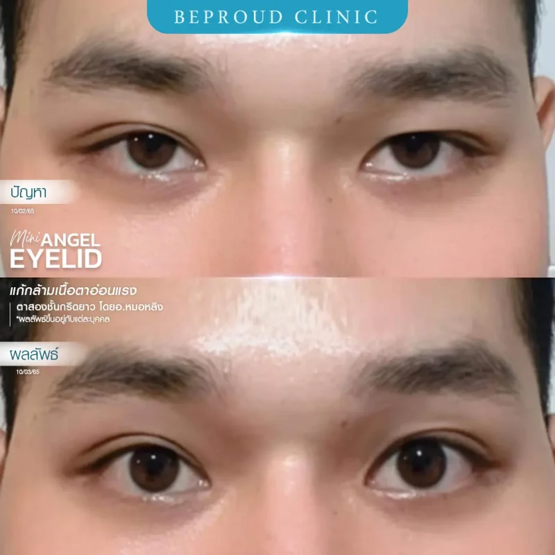 ภาพรีวิวเปรียบเทียบผลลัพธ์ ก่อนทำ-หลังทำศัลยกรรมตาสองชั้นผู้ชาย ของเคสตัวอย่าง เทคนิคกรีดยาว แก้กล้ามเนื้อตาอ่อนแรง โดยอ.หมอหลิง บีพราวด์คลินิก
