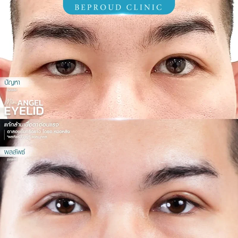 ภาพรีวิวเปรียบเทียบผลลัพธ์ ก่อนทำ-หลังทำศัลยกรรมตาสองชั้นผู้ชาย ของเคสตัวอย่าง เทคนิคกรีดยาว แก้กล้ามเนื้อตาอ่อนแรง โดยอ.หมอหลิง บีพราวด์คลินิก