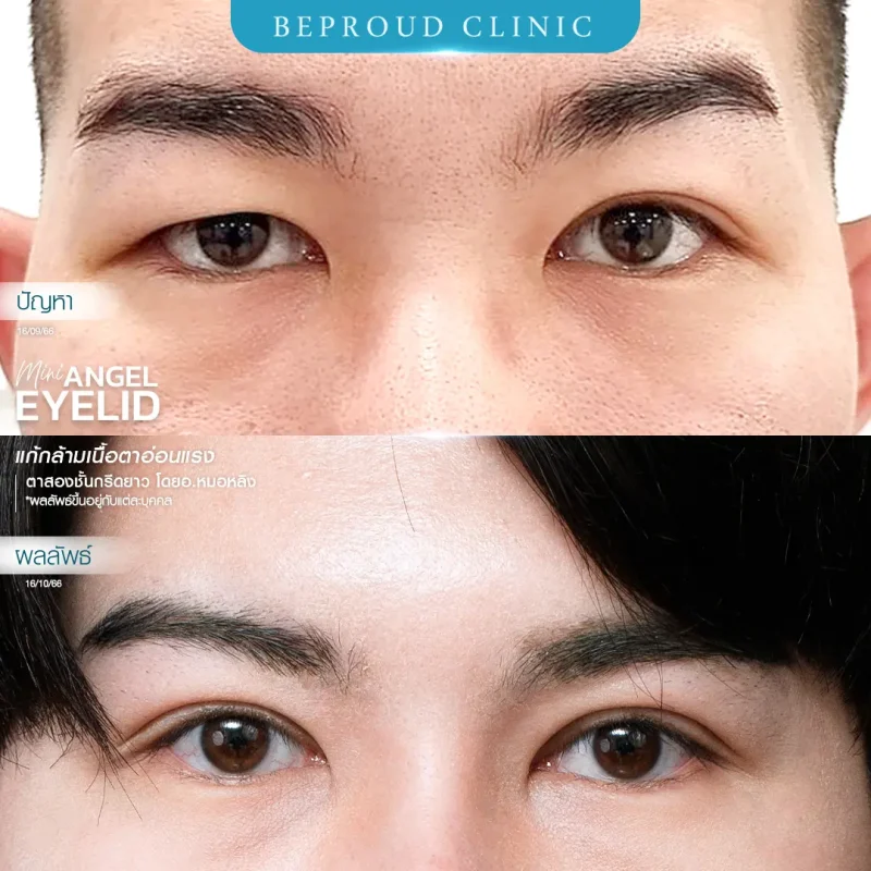 ภาพรีวิวเปรียบเทียบผลลัพธ์ ก่อนทำ-หลังทำศัลยกรรมตาสองชั้นผู้ชาย ของเคสตัวอย่าง เทคนิคกรีดยาว แก้กล้ามเนื้อตาอ่อนแรง โดยอ.หมอหลิง บีพราวด์คลินิก
