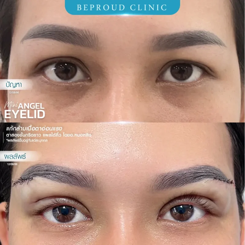 ภาพรีวิวเปรียบเทียบผลลัพธ์ ก่อนทำ-หลังทำศัลยกรรมตาสองชั้น ของเคสตัวอย่าง เทคนิคกรีดตายาว แก้กล้ามเนื้อตาอ่อนแรง แผลใต้คิ้ว โดยอ.หมอหลิง บีพราวด์คลินิก