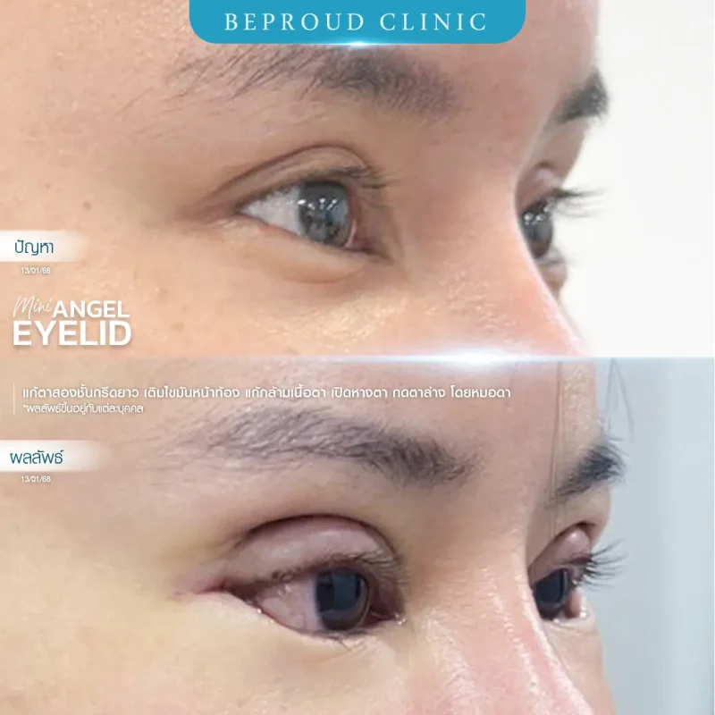 ภาพรีวิวเปรียบเทียบผลลัพธ์ ก่อนทำ-หลังทำศัลยกรรมแก้ตาสองชั้น ของเคสตัวอย่าง เทคนิคกรีดตายาว เติมไขมันหน้าท้อง แก้กล้ามเนื้อตาอ่อนแรง เปิดหางตา กดตาล่าง โดยหมอดา บีพราวด์คลินิก