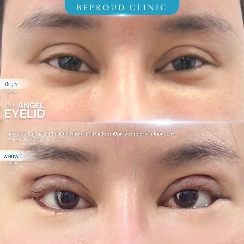 ภาพรีวิวเปรียบเทียบผลลัพธ์ ก่อนทำ-หลังทำศัลยกรรมแก้ตาสองชั้น ของเคสตัวอย่าง เทคนิคกรีดตายาว เติมไขมันหน้าท้อง แก้กล้ามเนื้อตาอ่อนแรง เปิดหางตา กดตาล่าง โดยหมอดา บีพราวด์คลินิก