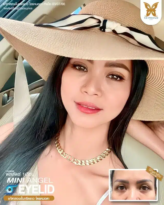 ภาพรีวิวคนสวย แก้ตาสองชั้นกรีดตายาว โดยหมอดา (พญ.สร้อยสุดา) บีพราวด์คลินิก แสดงผลลัพธ์ ชั้นตาสวยคมชัด ดวงตาดูสดใส
