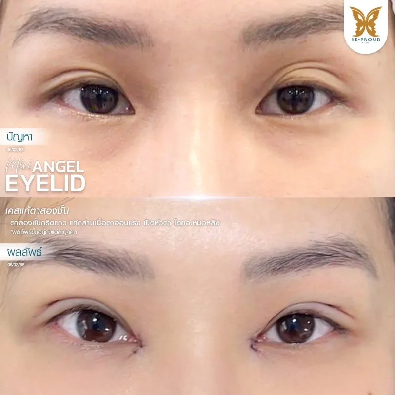 ภาพรีวิวเปรียบเทียบผลลัพธ์ ก่อนทำ-หลังทำศัลยกรรมแก้ตาสองชั้น ของเคสตัวอย่าง เทคนิคกรีดตายาว แก้กล้ามเนื้อตาอ่อนแรง เปิดหัวตา โดยอ.หมอหลิง บีพราวด์คลินิก