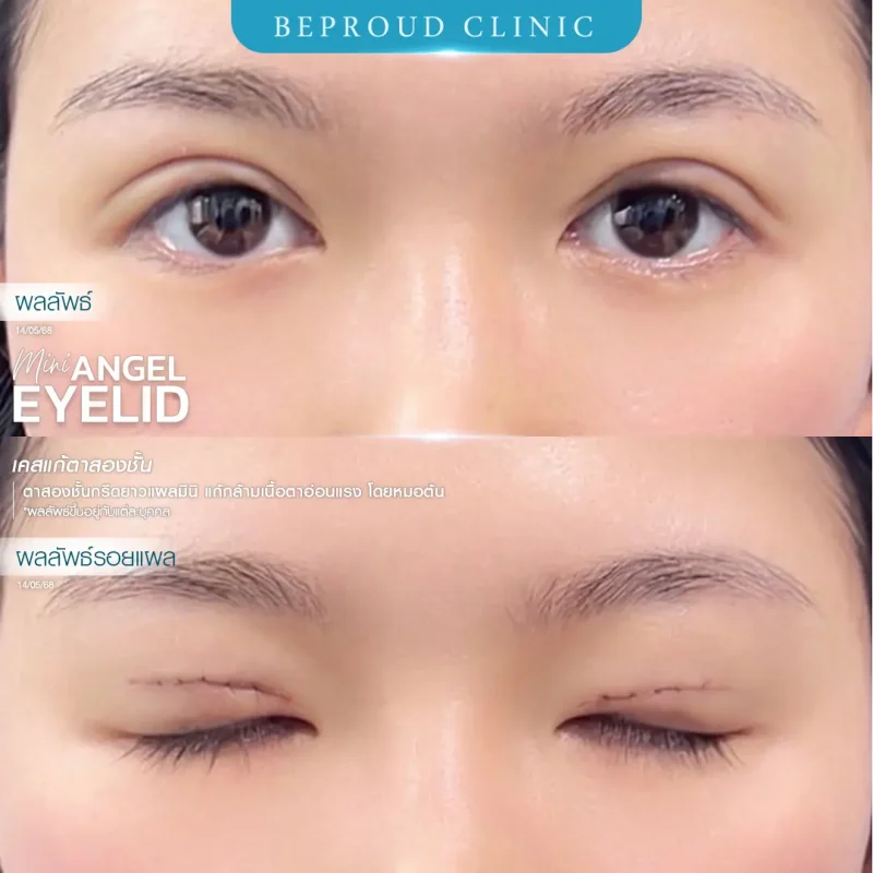 ภาพรีวิวเปรียบเทียบผลลัพธ์ ก่อนทำ-หลังทำศัลยกรรมแก้ตาสองชั้น ของเคสตัวอย่าง เทคนิคกรีดตายาว แผลมินิ แก้กล้ามเนื้อตาอ่อนแรง โดยหมอต้น บีพราวด์คลินิก