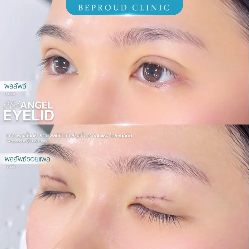 ภาพรีวิวเปรียบเทียบผลลัพธ์ ก่อนทำ-หลังทำศัลยกรรมแก้ตาสองชั้น ของเคสตัวอย่าง เทคนิคกรีดตายาว แผลมินิ แก้กล้ามเนื้อตาอ่อนแรง โดยหมอต้น บีพราวด์คลินิก