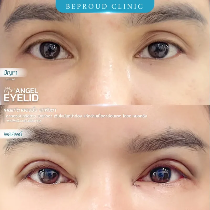 ภาพรีวิวเปรียบเทียบผลลัพธ์ ก่อนทำ-หลังทำศัลยกรรมแก้ตาสองชั้น ของเคสตัวอย่าง เทคนิคกรีดตายาว เปิดหัวตา เติมไขมันหน้าท้อง และแก้กล้ามเนื้อตาอ่อนแรง โดยอ.หมอหลิง บีพราวด์คลินิก