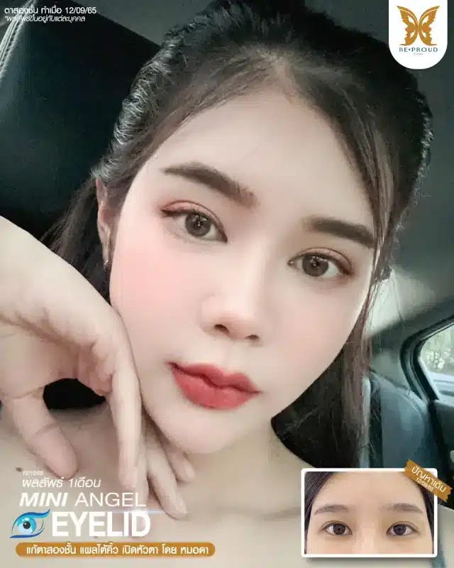 ภาพรีวิวคนสวย แก้ตาสองชั้นกรีดตายาว เปิดหัวตา แผลใต้คิ้ว โดยหมอดา (พญ.สร้อยสุดา) บีพราวด์คลินิก แสดงผลลัพธ์ ชั้นตาสวยคมชัด ดวงตาดูสดใส