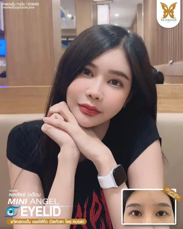 ภาพรีวิวคนสวย แก้ตาสองชั้นกรีดตายาว เปิดหัวตา แผลใต้คิ้ว โดยหมอดา (พญ.สร้อยสุดา) บีพราวด์คลินิก แสดงผลลัพธ์ ชั้นตาสวยคมชัด ดวงตาดูสดใส