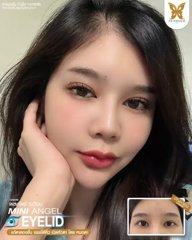 ภาพรีวิวคนสวย แก้ตาสองชั้นกรีดตายาว เปิดหัวตา แผลใต้คิ้ว โดยหมอดา (พญ.สร้อยสุดา) บีพราวด์คลินิก แสดงผลลัพธ์ ชั้นตาสวยคมชัด ดวงตาดูสดใส