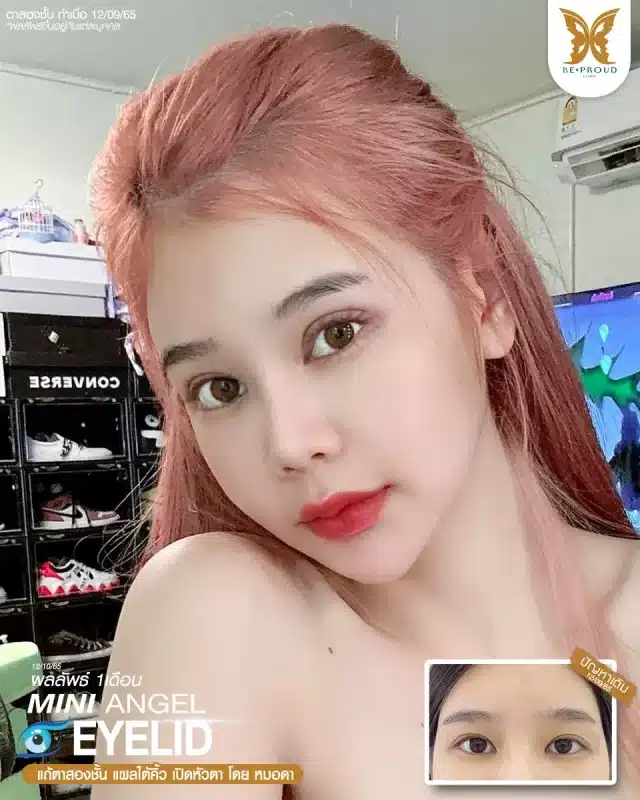 ภาพรีวิวคนสวย แก้ตาสองชั้นกรีดตายาว เปิดหัวตา แผลใต้คิ้ว โดยหมอดา (พญ.สร้อยสุดา) บีพราวด์คลินิก แสดงผลลัพธ์ ชั้นตาสวยคมชัด ดวงตาดูสดใส