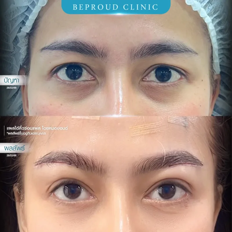 ภาพรีวิวเปรียบเทียบผลลัพธ์ ก่อนทำ-หลังทำศัลยกรรมแผลใต้คิ้วซ่อนแผล โดยหมอปอนด์ บีพราวด์คลินิก