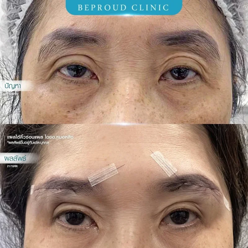 ภาพรีวิวเปรียบเทียบผลลัพธ์ ก่อนทำ-หลังทำศัลยกรรมแผลใต้คิ้วซ่อนแผล โดยอ.หมอหลิง บีพราวด์คลินิก