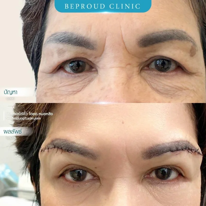 ภาพรีวิวเปรียบเทียบผลลัพธ์ ก่อนทำ-หลังทำศัลยกรรมแผลใต้คิ้ว โดยอ.หมอหลิง บีพราวด์คลินิก