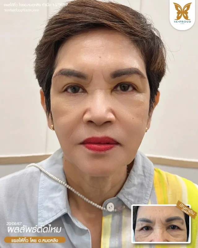 ภาพรีวิวคนสวย แผลใต้คิ้ว โดย อ.หมอหลิง (พญ.กัญญ์ชิสา) บีพราวด์คลินิก แสดงผลลัพธ์ ชั้นตาสวยคมชัด ดวงตาดูสดใส