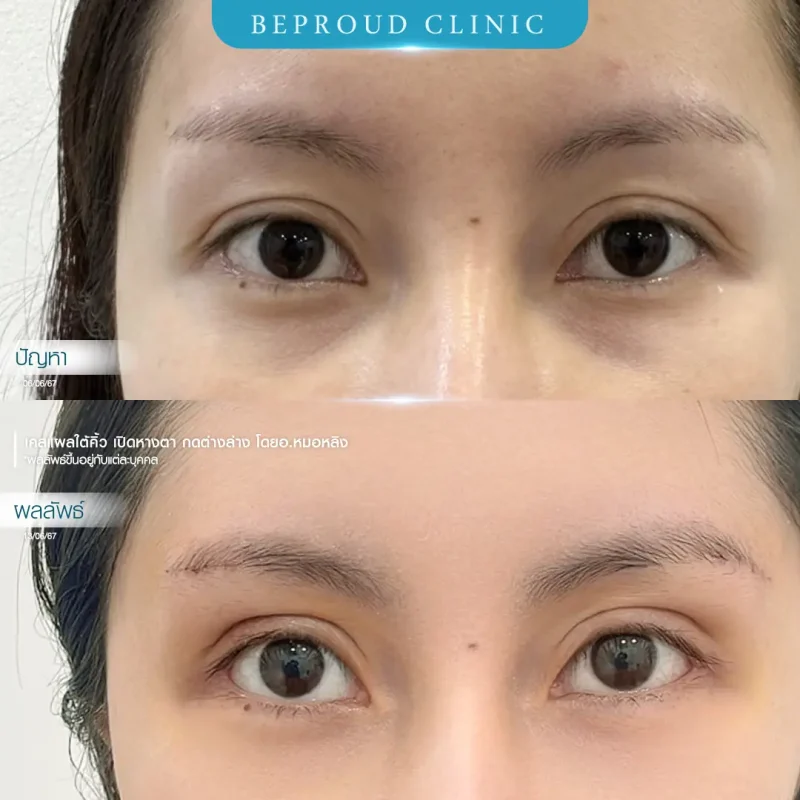 ภาพรีวิวเปรียบเทียบผลลัพธ์ ก่อนทำ-หลังทำศัลยกรรม ของเคสตัวอย่าง เปิดหางตาและกดตาล่าง แผลใต้คิ้ว โดยอ.หมอหลิง บีพราวด์คลินิก
