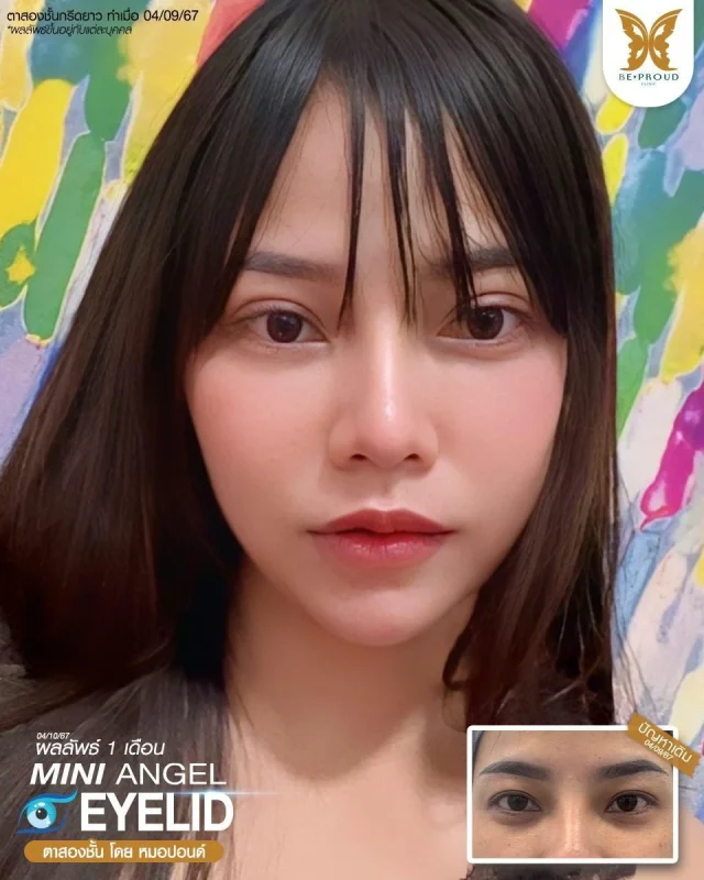 ภาพรีวิวคนสวย ตาสองชั้นกรีดตายาว โดยหมอปอนด์ (นพ.พิชญ์) บีพราวด์คลินิก แสดงผลลัพธ์ ชั้นตาสวยคมชัด ดวงตาดูสดใส