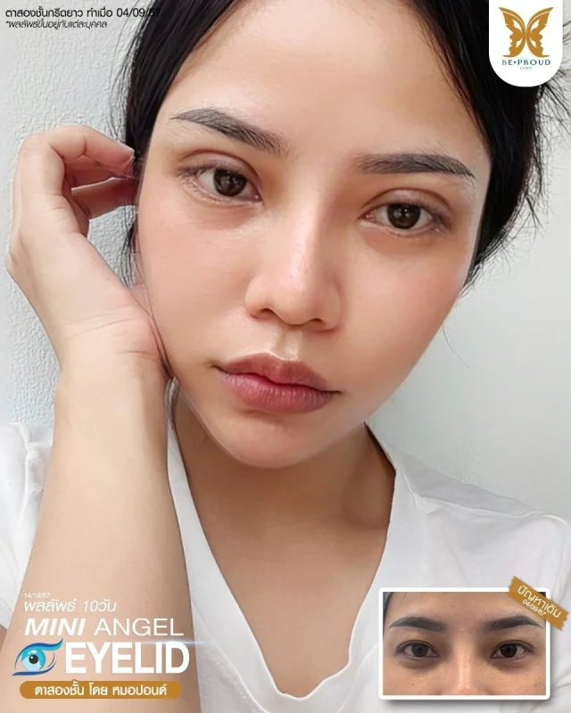 ภาพรีวิวคนสวย ตาสองชั้นกรีดตายาว โดยหมอปอนด์ (นพ.พิชญ์) บีพราวด์คลินิก แสดงผลลัพธ์ ชั้นตาสวยคมชัด ดวงตาดูสดใส