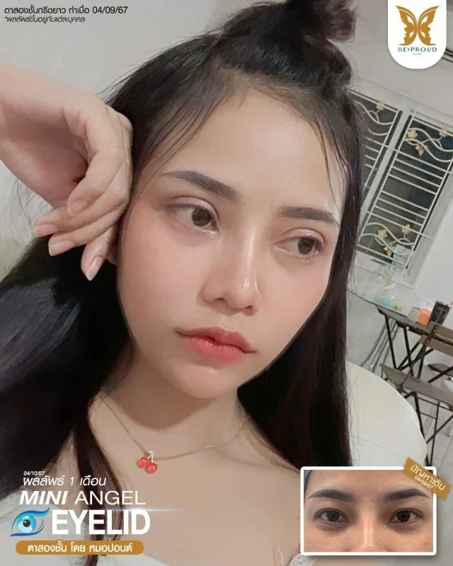 ภาพรีวิวคนสวย ตาสองชั้นกรีดตายาว โดยหมอปอนด์ (นพ.พิชญ์) บีพราวด์คลินิก แสดงผลลัพธ์ ชั้นตาสวยคมชัด ดวงตาดูสดใส