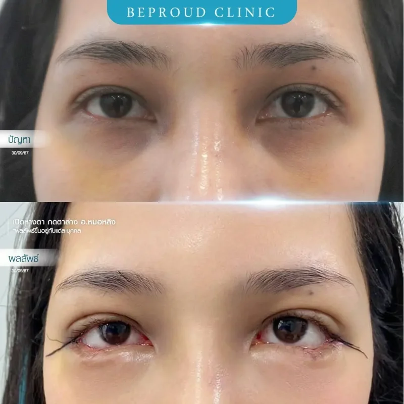 ภาพรีวิวเปรียบเทียบผลลัพธ์ ก่อนทำ-หลังทำศัลยกรรม ของเคสตัวอย่าง เปิดหางตาและกดตาล่าง โดยอ.หมอหลิง บีพราวด์คลินิก