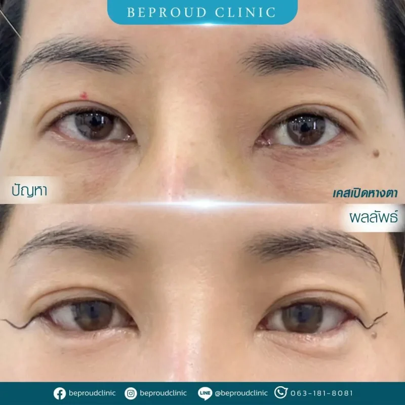 ภาพรีวิวเปรียบเทียบผลลัพธ์ ก่อนทำ-หลังทำศัลยกรรม ของเคสตัวอย่าง เปิดหางตา กดตาล่าง โดยอ.หมอหลิง บีพราวด์คลินิก